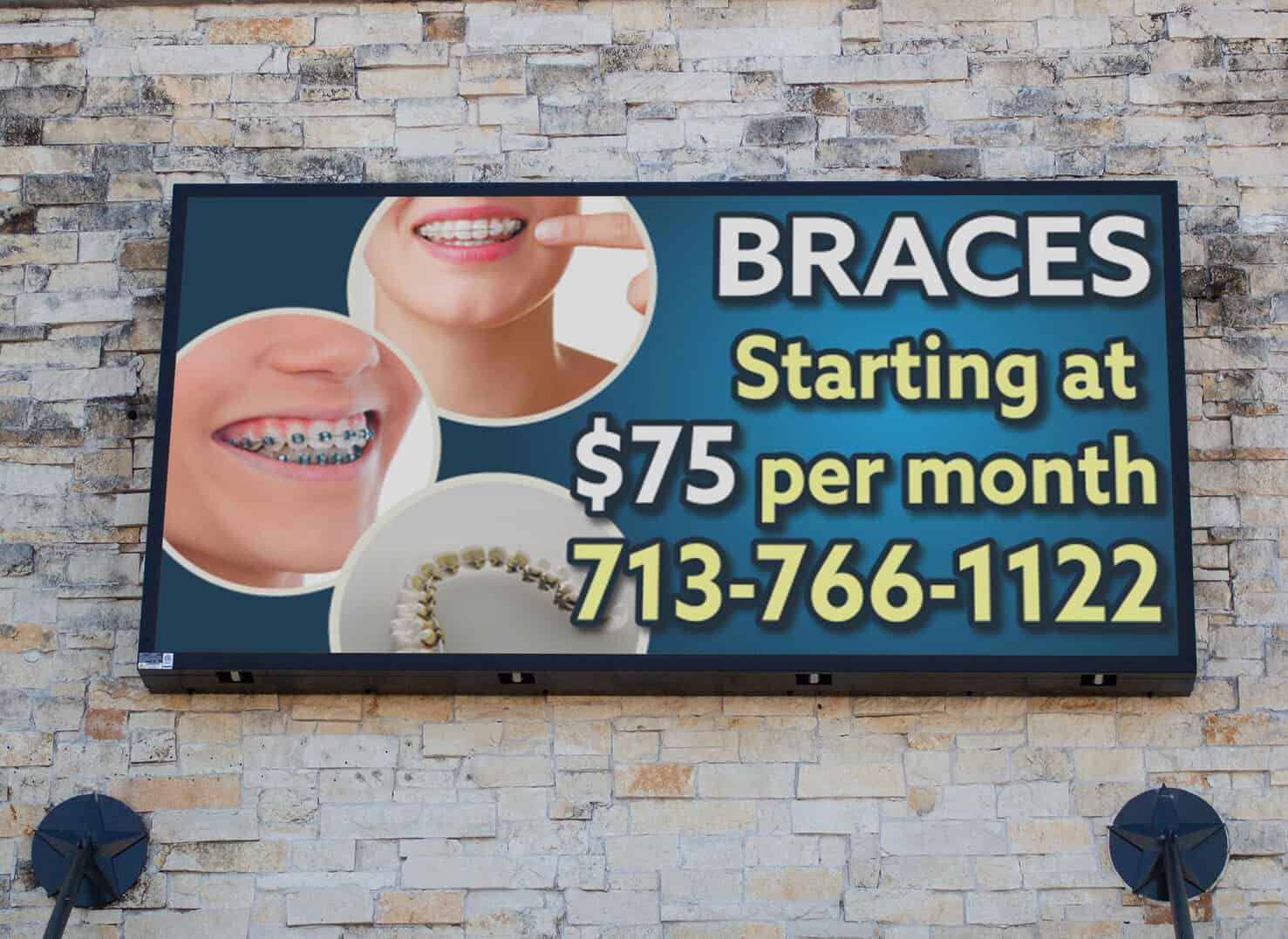 Kids Braces - Zara Dental Clinic - Houston - (713) 766 1122